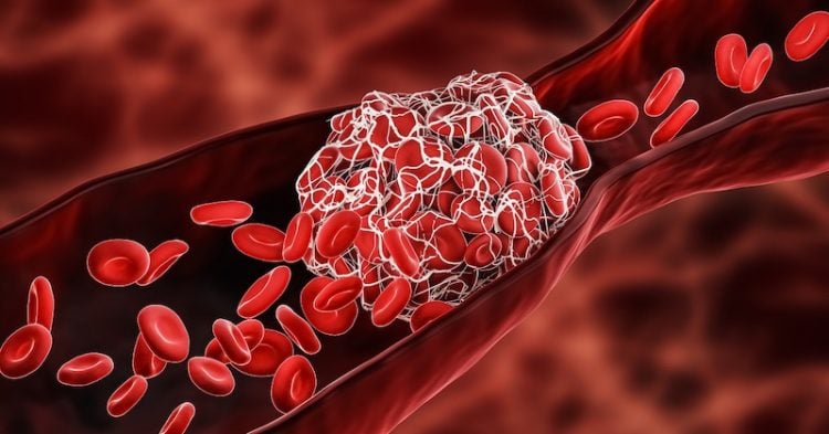 Blood Clot or thrombus blocking the red blood cells stream within an artery or a vein 3D rendering illustration. Thrombosis, cardiovascular system, medicine, biology, health, anatomy, pathology concepts.